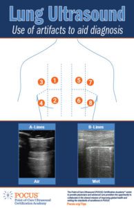 POCUS Lung Ultrasound | Tips & Infographics | POCUS.org