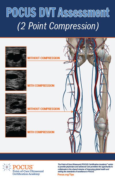 DVT Ultrasound Made Easy: Step-By-Step Guide POCUS 101, 50% OFF