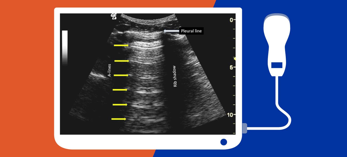 Introduction to Chest Point of Care Ultrasound