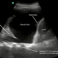 Point-of-Care Ultrasound (POCUS) COVID-19 Lung Clinical Cases