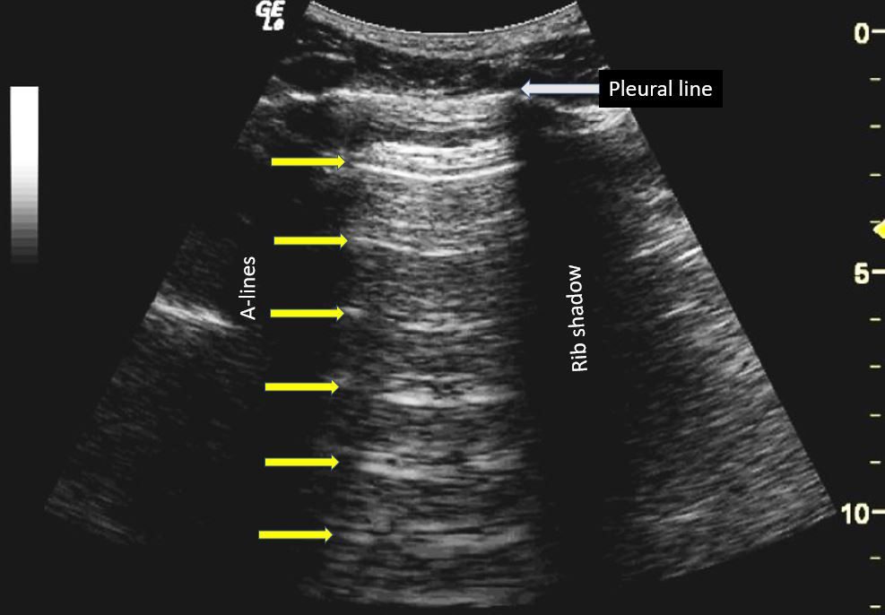 COVID-19 And The Role Of Point Of Care Ultrasound