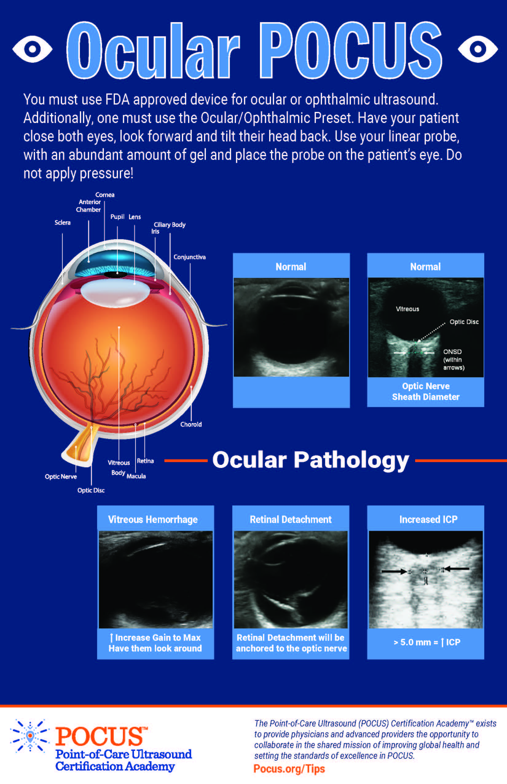 Ocular POCUS | POCUS Resources & Case Studies | POCUS.org