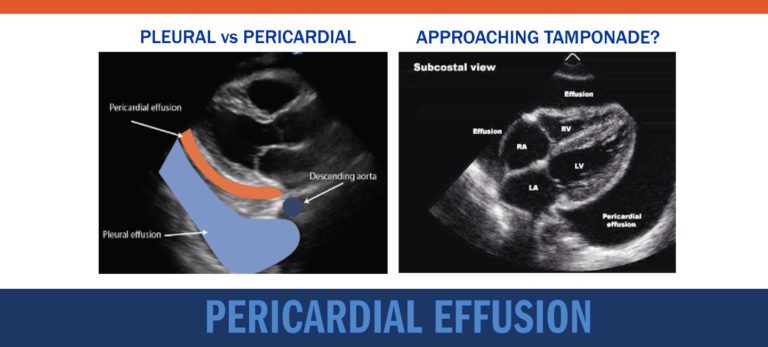 Pericardial Effusion | POCUS Resources & Case Studies | POCUS.org