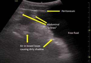 Abdominal Pain | Case Studies | POCUS.org