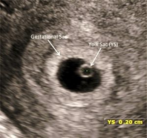 Introduction to First-Trimester Point-of-Care Ultrasound - Point-of ...