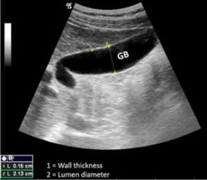 Role of POCUS in Diagnosing Acute Cholecystitis and its Life ...