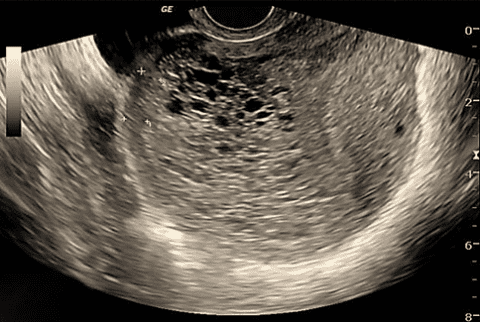 Molar Pregnancy | Point-of-Care Ultrasound Certification Academy