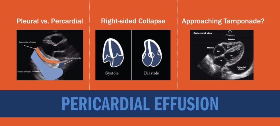 Pericardial Effusion | POCUS Resources & Case Studies | POCUS.org