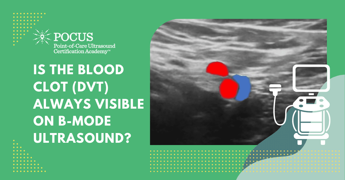 Deep Vein Thrombosis (DVT) – Is The Blood Clot (DVT) Always Visible On ...