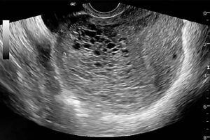 case presentation of molar pregnancy