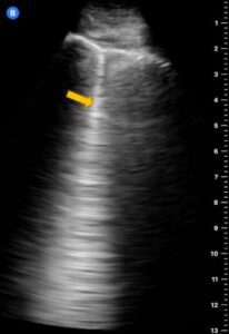 Small Pleural Effusion | POCUS Resources & Case Studies | POCUS.org