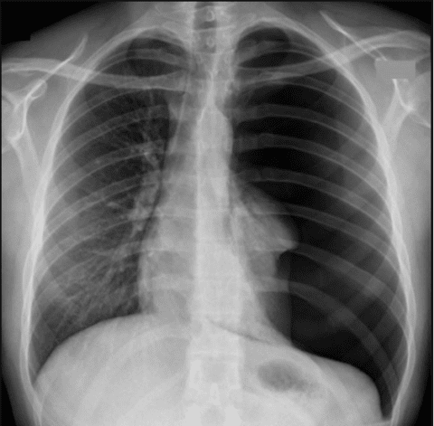 Pneumothorax – Can POCUS Lung Help? - Point-of-Care Ultrasound ...