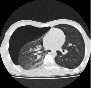 Pneumothorax – Can POCUS Lung Help? - Point-of-Care Ultrasound ...