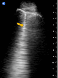 Pneumothorax Can Pocus Lung Help Point Of Care Ultrasound Certification Academy