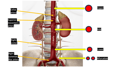 How to Measure an Abdominal Aorta Diameter/Abdominal Aortic Aneurysm ...