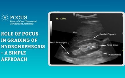 Role of Point of Care Ultrasound (POCUS) in Grading of Hydronephrosis – A Simple Approach