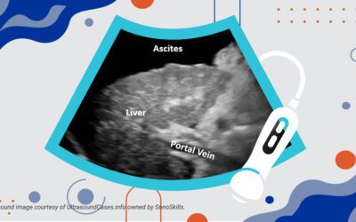 Role of Point of Care Ultrasound (POCUS) in Diagnosing Ascites