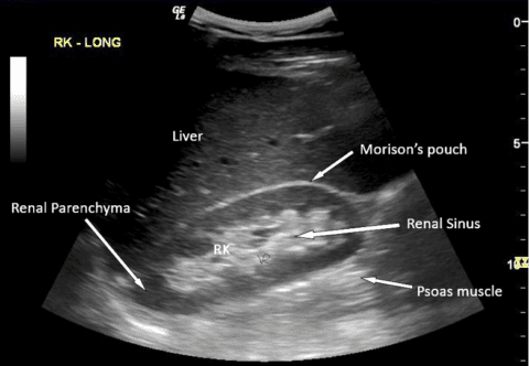 Role of Point of Care Ultrasound (POCUS) in Diagnosing Ascites - Point ...