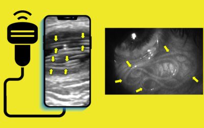 Dirofilariasis in Humans: A Rare POCUS (Point-of-Care Ultrasound) Spot Diagnosis