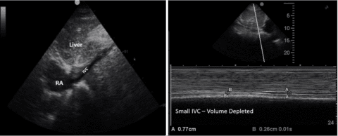 Inferior Vena Cava (IVC) Assessment for Volume Status in Point-of-Care ...