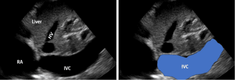 Inferior Vena Cava (IVC) Assessment for Volume Status in Point-of-Care ...