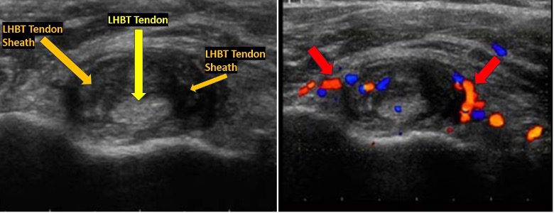 Tenosynovitis