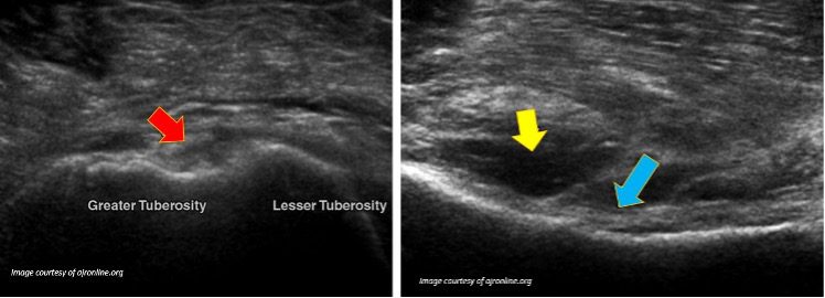 Partial thickness tear