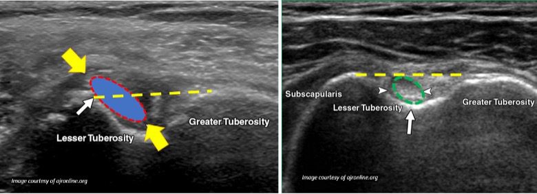 Sublaxation labeled