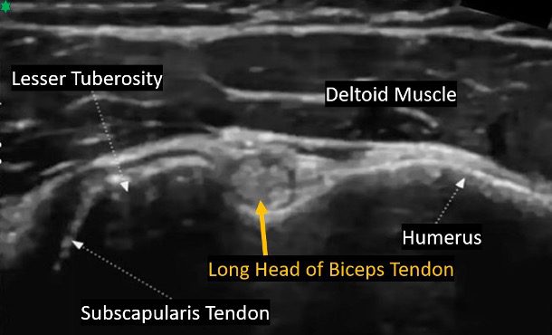 Transverse view of long head bicep