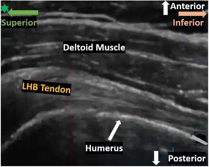 Longitudinal view of long head bicep