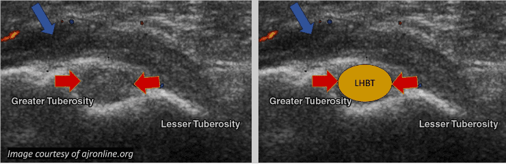 Tendinosis