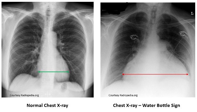 Chest xray