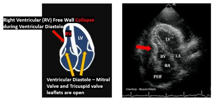 Diastollic collapse