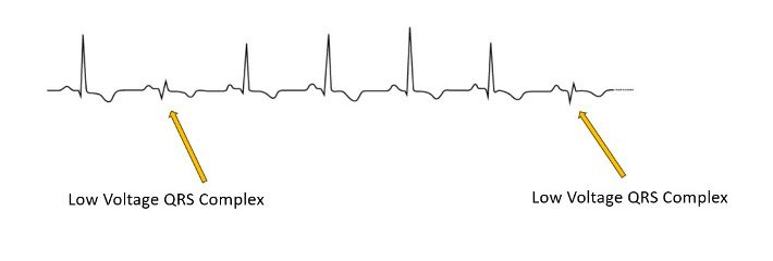 EKG