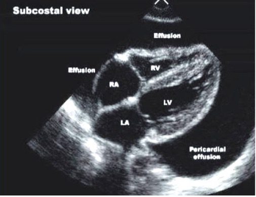 Pericardial effussion