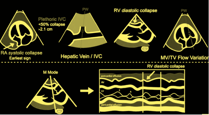 Tamponade graphic