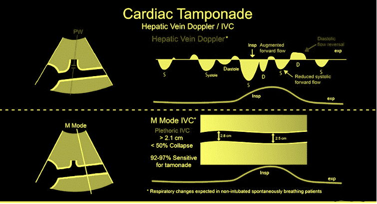 Tamponade graphic